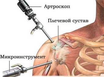  _434_https://www.vrach-travmatolog.ru/img/content/artroskopiya-plechevogo-sustava.jpg