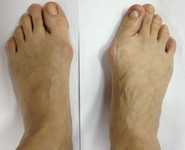  _343_https://www.vrach-travmatolog.ru/img/content/before-hallux-valgus-01-sml.jpg