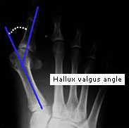  _483_https://www.vrach-travmatolog.ru/img/content/hallux-valgus-angle-1.jpg