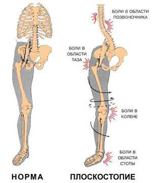  _292_https://www.vrach-travmatolog.ru/img/content/poperechnoe-ploskostopie.jpg