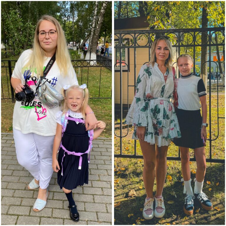 Мини-гастрошунтирование лапароскопическое с холецистэктомией 5 whatsapp image 2025 10 06 at 13.49.00
